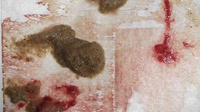تصویر خون در مدفوع