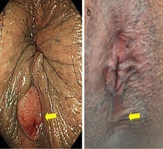 تصویر: https://jarah.clinic/wp-content/uploads/2019/07/The-second-external-opening-of-an-anal-fistula-was-noted-behind-the-anus-b-After-NAC.png.jpg