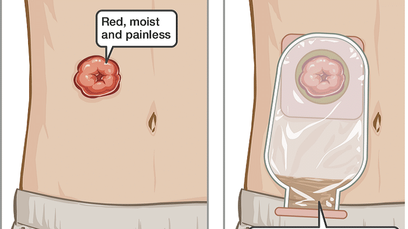 [تصویر:  IMD_ostomy_pouch_EN.png]