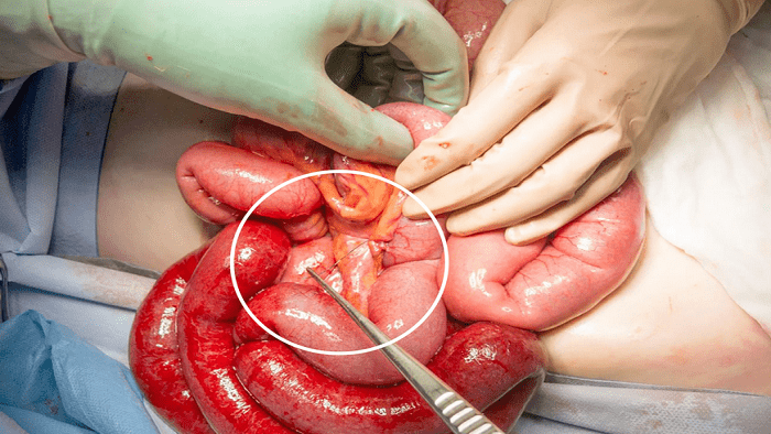 عمل جراحی سرطان روده کوچک