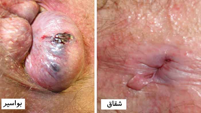 عکس شقاق و بواسیر