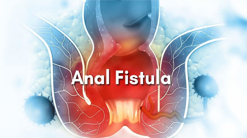 فیستول چیست؟ علت، علائم و تشخیص بیماری فیستول مقعدی