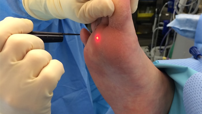 درمان زگیل پا با لیزر