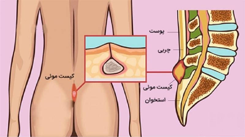 درمان کیست مویی با لیزر بدون جراحی و عمل در تهران