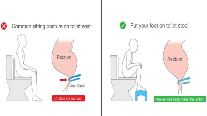 نشستن صحیح در توالت برای مبتلایان به بواسیر